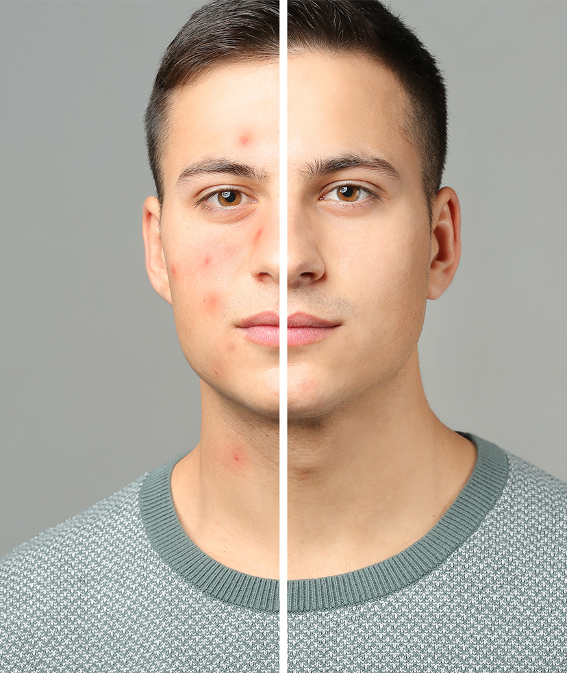 Man before and after acne treatments