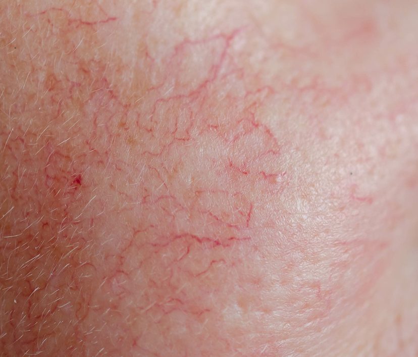 Close-up on facial veins