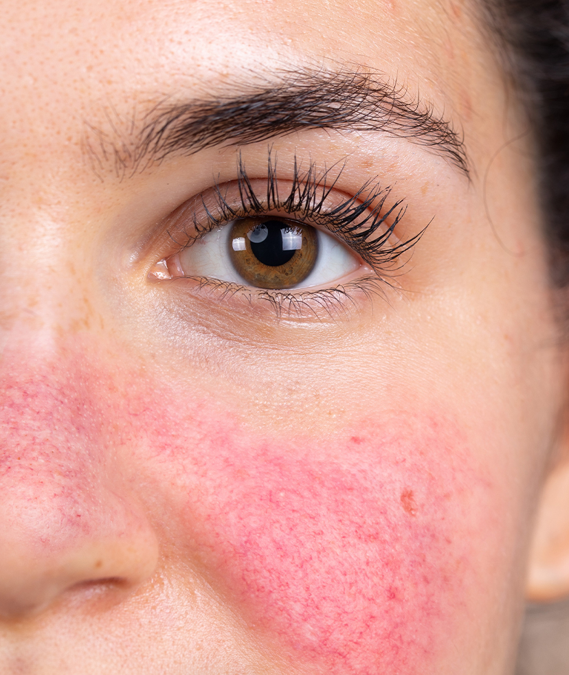 Close-up on rosacea on a woman's face