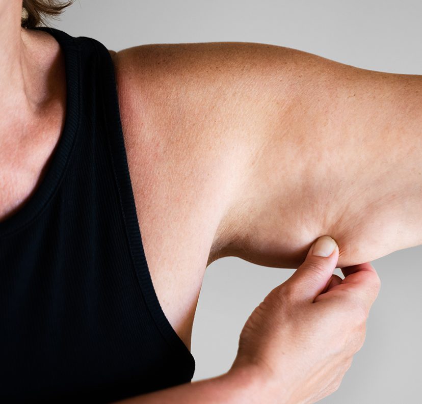 Woman pulling on sagging skin on her arm