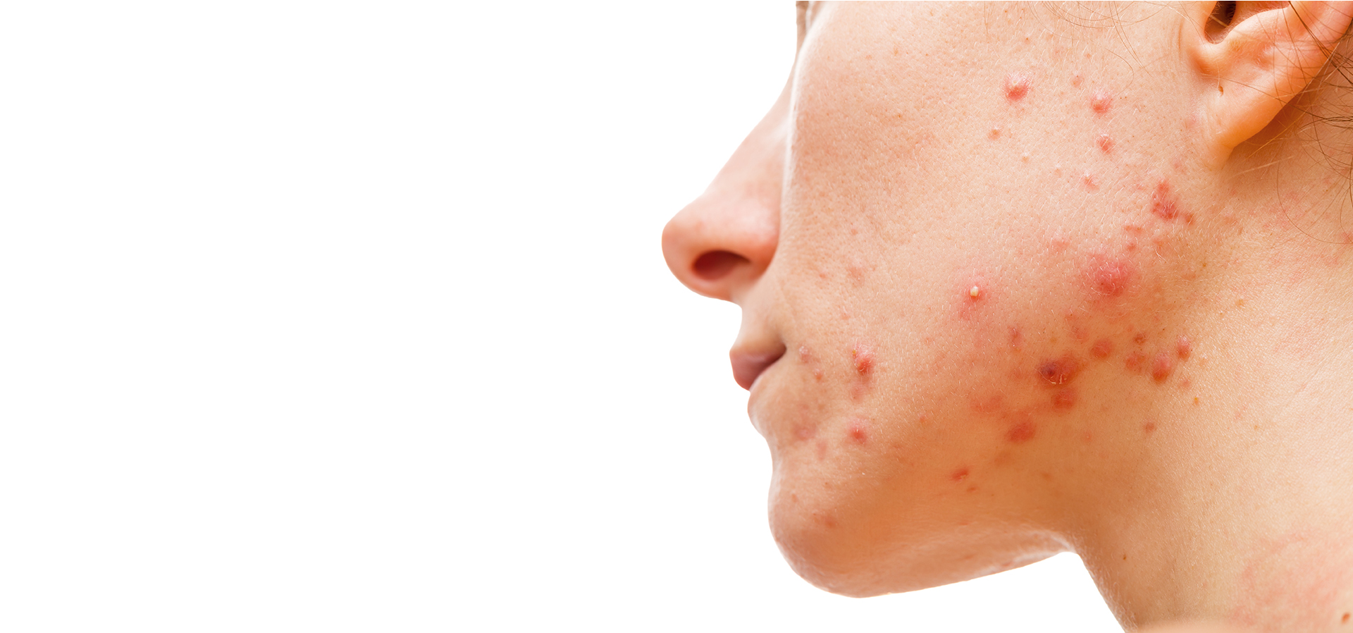 Woman's face with acne and acne scars