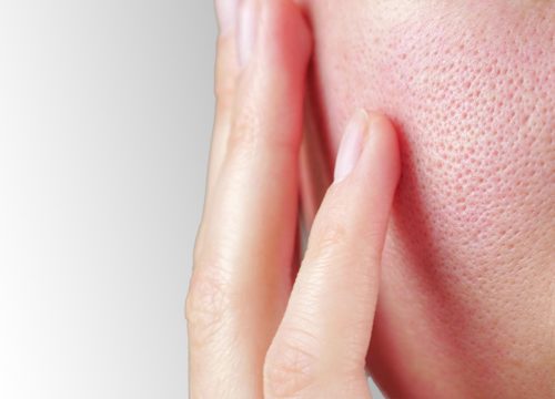 Enlarged pores on a person's face