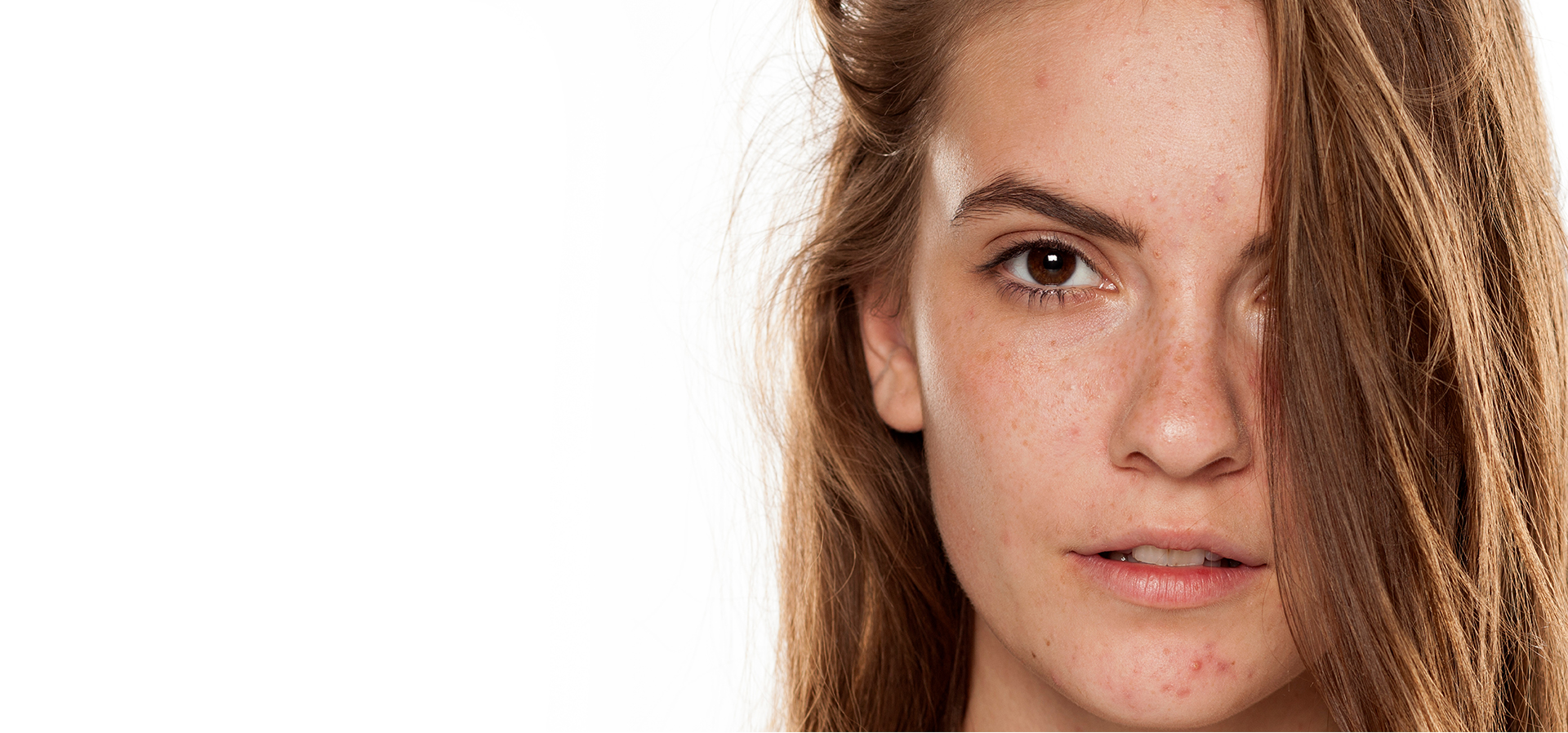 Uneven Skin Tone
