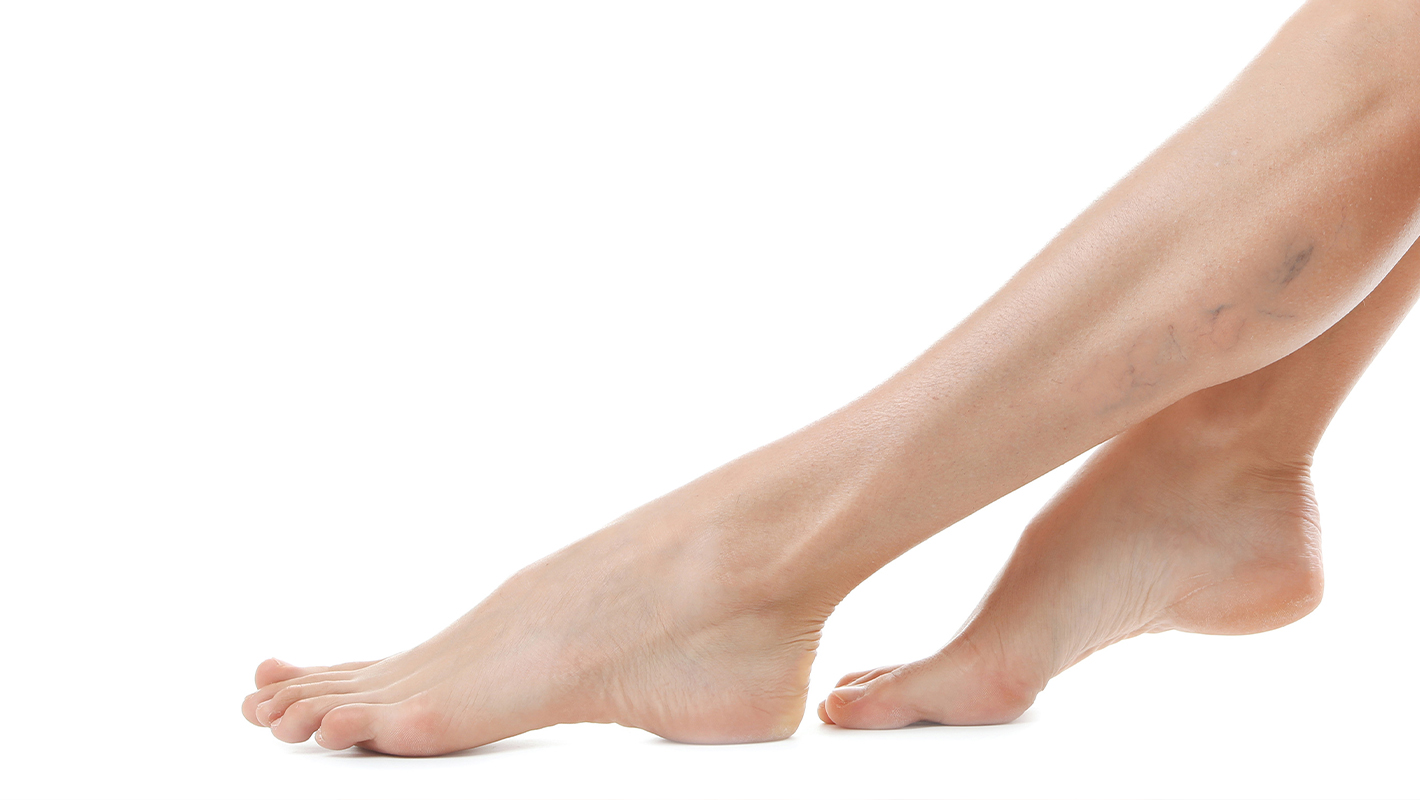 Sclerotherapy